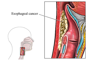 Esophageal Cancer Treatment India, Esophagus, Esophagus Cancer India